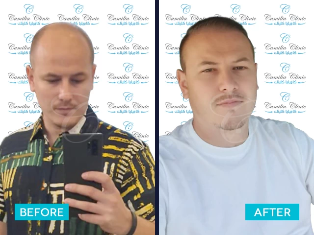 نتائج استعادة الشعر بتقنية DHI في تركيا