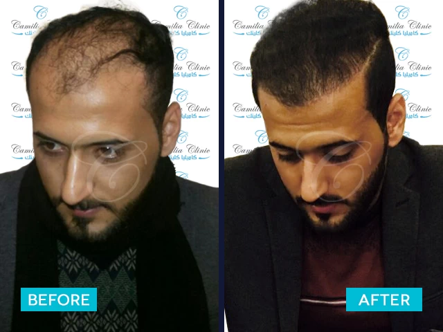 نتائج زراعة الشعر بكثافة عالية باستخدام تقنية DHI في تركيا