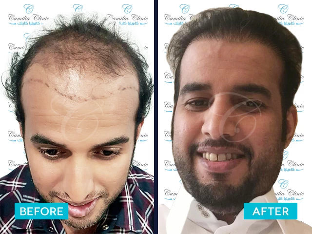 قبل وبعد زراعة الشعر بشكل جزئي بتقنية DHI في تركيا