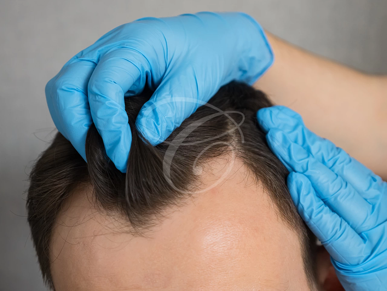 علاج تساقط الشعر والصلع والشعر الخفيف بزراعة الشعر