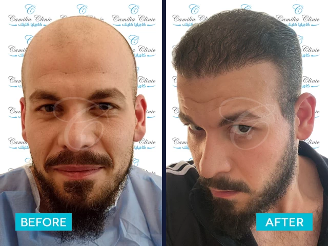 نتائج زراعة شعر الرأس بالكامل بتقنية السفير في تركيا